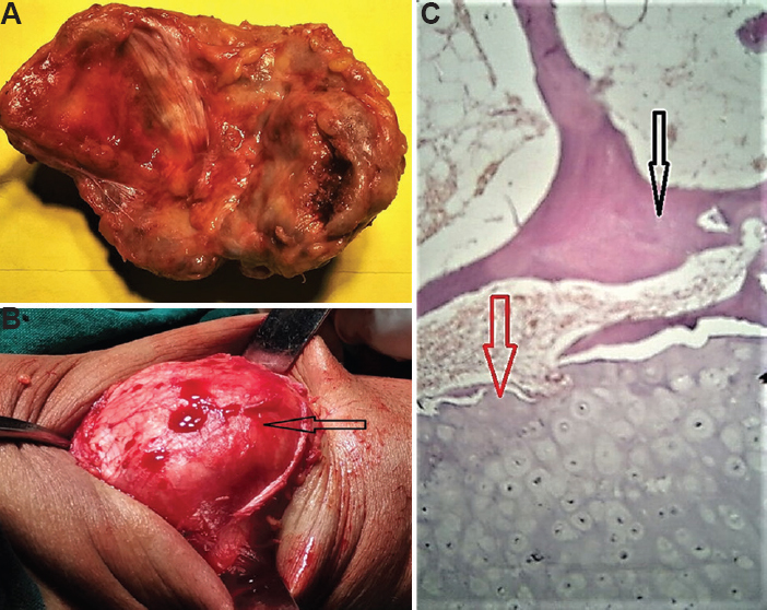 (A) The inner aspects of the excised mass (about 8 cm × 6 cm) with variegated appearance and bony hard. (B) The intact patella (arrow), following the excision of the mass, with no remnants of the same denoting that the lesion existed as a separate overlying structure. (C) The histological features showing the presence of bony elements (black arrow) (H and E, ×10) and varying thickness of cartilage cap layer (red arrow) over its outer surface with bluish tinge, suggestive of an extra-skeletal osteochondroma.
